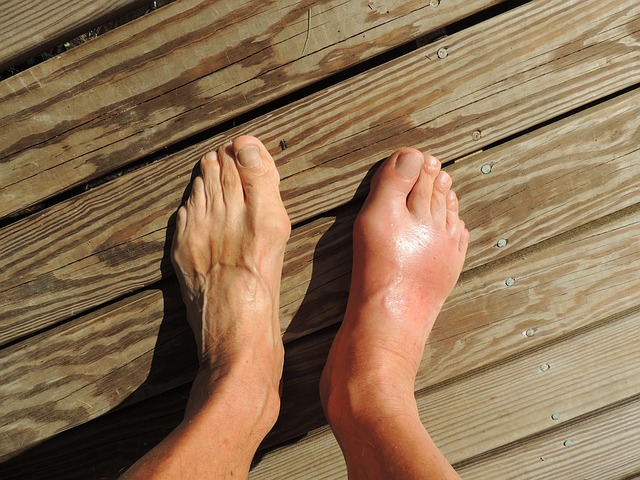 足の指の付け根 腫れ